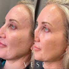 ✨ The glow is real! ✨ Check out the magic of chemical peels + medical-grade  skincare! 😱👏🏻 This beauty is shining after just her FIRST ZO 3-Step  Peel! It helped lighten sunspots,