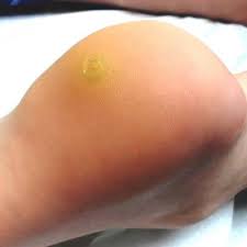 The doctor asked if the patient took much exercise. The Most Problematic Warts Have No Sure Treatment Clinician Reviews
