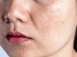 Overview many people of color suffer from something called hyperpigmentation. when you receive a cut, zit, or scratch on your skin, the area turns if you are suffering from uneven hyperpigmentation on your face or body, there are some natural remedies that you can try before resorting to. Ways To Get Rid Of Hyperpigmentation Naturally
