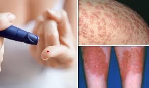 Check spelling or type a new query. Diabetes Type 2 Symptoms Signs Of High Blood Sugar On Skin And Spots Express Co Uk