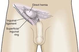 Image result for Hernia Reduction