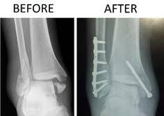 30 Ankle Images Broken Ankle Ankle Surgery Ankle Fracture