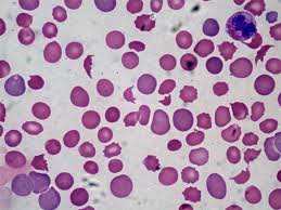 Anemia