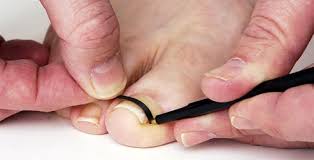 self care on how to treat ingrown toenails