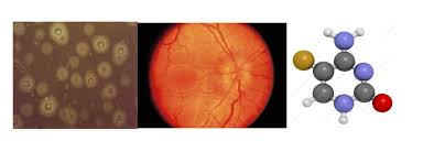 Image result for Cryptococcal Meningitis