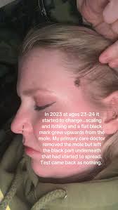 My Birth Mark Turned into Melanoma