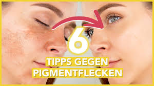 Das darin enthaltene zinkoxid sorgt dafür. Pigmentflecken Entfernen Die 6 Besten Tipps Gegen Hyperpigmentierung Youtube