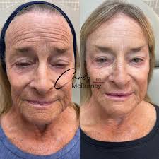 Hi there! My name is Carly 👋🏼 I'm an aesthetic nurse injector dedicated  to helping you achieve your beauty goals. I've been injecting for 16 years!  With a passion for precision and