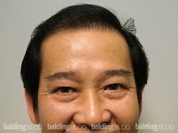 Asian hair loss and thinning. Transplanting Asian Hair With Photos Wrassman M D Baldingblog