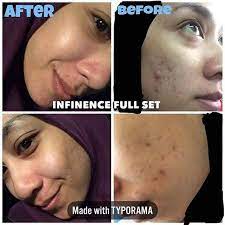 Hilangkan Jerawat Parut Jerawat Dengan Infinence Skincare Set Travel Kit Trial Set Rm157 50 159 50 Cle Movie Posters Incoming Call Screenshot Movies