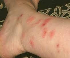 These can sometimes look like mosquito bites and appear as small, red, puffy lumps in a cluster of. What Does A Spider Bite Look Like How To Identify A Spider Bite Spider Bite Pictures