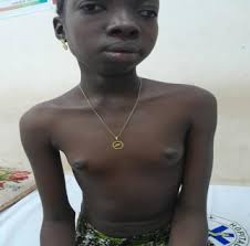 Scholars Journal of Medical Case Reports Pubertal Delay Secondary to  Hashimoto's Disease in the Hypothyroid Phase: About a C