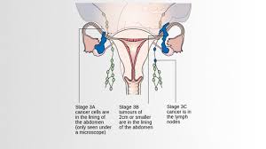 Ovarian cancer and irritable bowel syndrome or ibs (a functional disorder of the digestive tract) share symptoms like abdominal pain and cramping, diarrhea, constipation, gas, and bloating. Ovarian Cancer Pictures Symptoms And Diagnosis