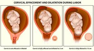 The cervix can be dilated to 1 centimeter for weeks before the beginning of labor. Cervix Dilation Signs And Procedure To Dilate