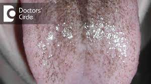 It occurs when bismuth combines with the sulfur that's in saliva, forming bismuth sulfide. How To Remove Black Spots On Tongue Dr Aarthi Shankar Youtube