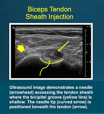 Image result for Biceps Tendon Injection