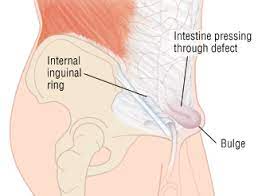Groin pain might occur immediately after an injury, or pain might come on gradually over a period of weeks or even months. Inguinal Hernia Harvard Health
