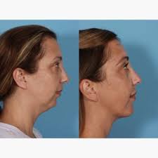 BUCKINGHAM CENTER FOR FACIAL PLASTIC SURGERY