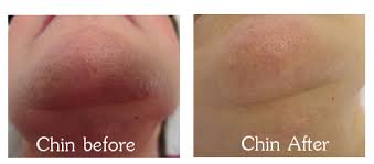 It is important to note that women with pcos will most likely not experience permanent hair loss with the laser due to the excess male hormones in the body. Polycystic Ovary Syndrome Pcos And Hair Removal The Laserina Clinic Manchester Trafford