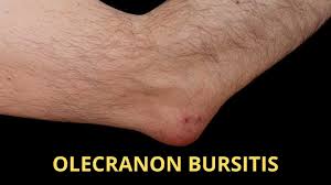 The ulna of notoryctes has an enormous hooked olecranon which causes the bone to be nearly twice as long as the radius. Olecranon Bursitis Treatment Shoulder Elbow Surgeon