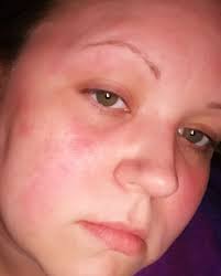 Any recommendations for treating a facial burn spot?