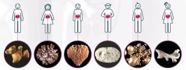 Types Of Kidney Stones May Need This In Case They Ever Come Back Kidney Stones Kidney Stones Remedy Stone Case