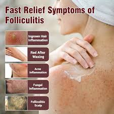 Image result for folliculitis symptoms