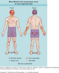 Merkel cell cancer often grows in older adults. Merkel Cell Carcinoma Plastic Surgery Key