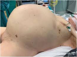 Image result for Megacolon