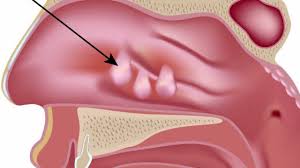Nasal Polyps - Causes, Symptoms and Treatment - Boys Town Hospital - YouTube