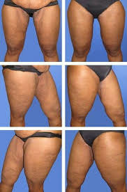 To Rid My Saggy Skin And Stretch Marks And Uneven Skin Tone Saggy Skin Health And Beauty Tips Uneven Skin
