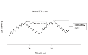 Intracranial Pressure Monitoring Gold Standard And Recent