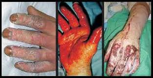 Resultado de imagen para QUEMADURAS