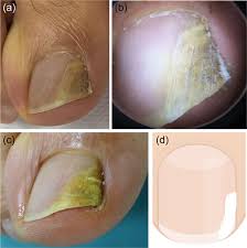 Image result for Onycholysis feet