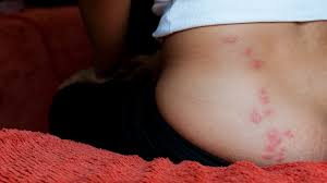 Image result for bedbugs bites