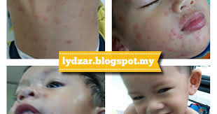 Cara berkesan hilangkan parut chicken pox dengan vitamin. Cara Merawat Chicken Pox Pada Anak Kecil Mencipta Hidup Bermakna