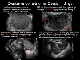 Chist Endometriozic Endometriom Diagnostic Medical Sonography Ultrasound Ultrasound Technician