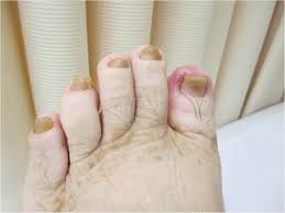 Image result for Yellow nail syndrome feet