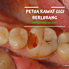 Terkadang sakit gigi juga di sertai dengan rasa sakit kepala yang hebat. Petua Rawat Gigi Berlubang Pengedar Shaklee Sah Malaysia
