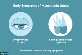 Myasthenia gravis results from an autoimmune attack on postsynaptic acetylcholine receptors, which disrupts neuromuscular transmission. Myasthenia Gravis Overview And More