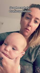 Craniosynostosis Symptoms