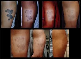 Laser hair removal can remove unwanted hair. Does Tattoo Removal Scar Elegant Arts Tattoo