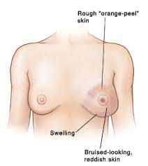 Other symptoms of inflammatory breast cancer include: Inflammatory Breast Cancer Saint Luke S Health System