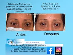 La Orbitopatía Distiroidea puede cursar con diversas alteraciones a nivel  periocular que ocasiona incomodidad cosmética y funcional entre las que  destaca la presencia de exoftalmos , retracción palpebral, Estrabismo  Restrictivo Ojo seco,