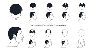 Последние твиты от lewis hamilton (@lewishamilton). Kann Haarausfall Mit Der Norwood Hamilton Skala Gemessen Werden