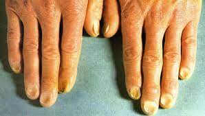 Here you see the spoon shaped nails condition is known as kolinychia, seen in iron deficiency anemia. Koilonychia Causes Symptoms Treatment
