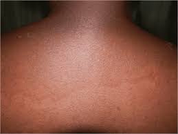 Image result for Photodermatitis