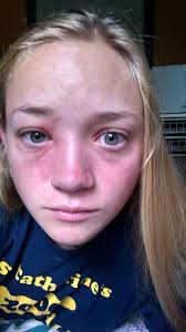 B&A] effects of a 9 day course of prednisone to treat poison ivy all over  my face : r/SkincareAddiction