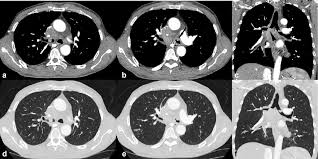 Advanced lung cancer means the cancer has spread from the lung to somewhere else in the body. Combination Of Bronchial Arterial Infusion Chemotherapy Plus Drug Eluting Embolic Transarterial Chemoembolization For Treatment Of Advanced Lung Cancer A Retrospective Analysis Of 23 Patients Journal Of Vascular And Interventional Radiology