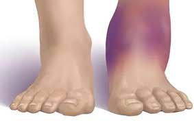 Image result for Compartment Syndrome